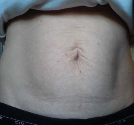 Abdomen-Skin-Laxity-1-after