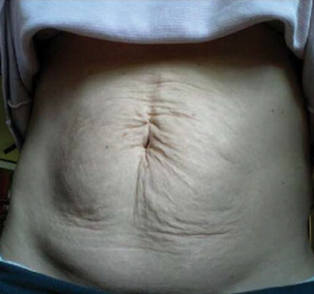 Abdomen-Skin-Laxity-1-before