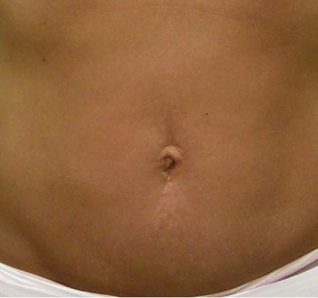 Abdomen-Skin-Laxity-2-after