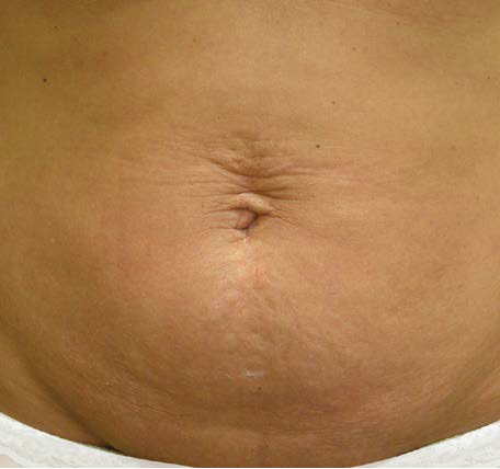 Abdomen-Skin-Laxity-2-before