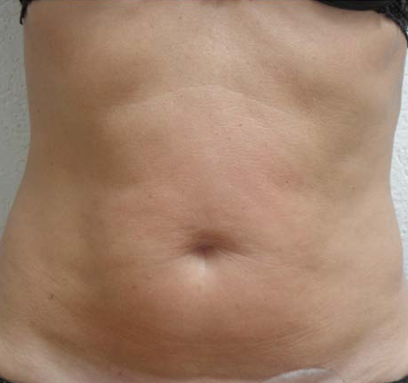 Abdomen-Skin-Laxity-3-after