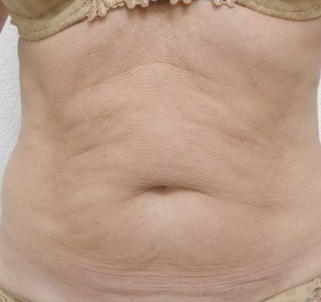 Abdomen-Skin-Laxity-3-before