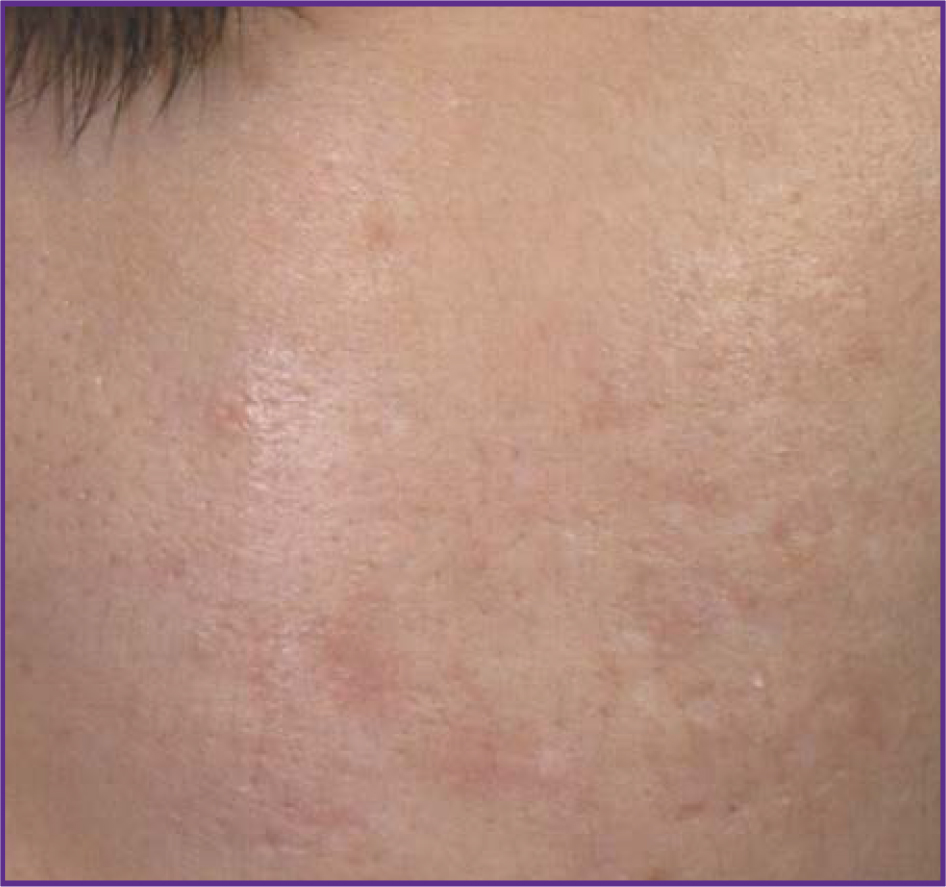 Fractional-Skin-Resurfacing-01-after