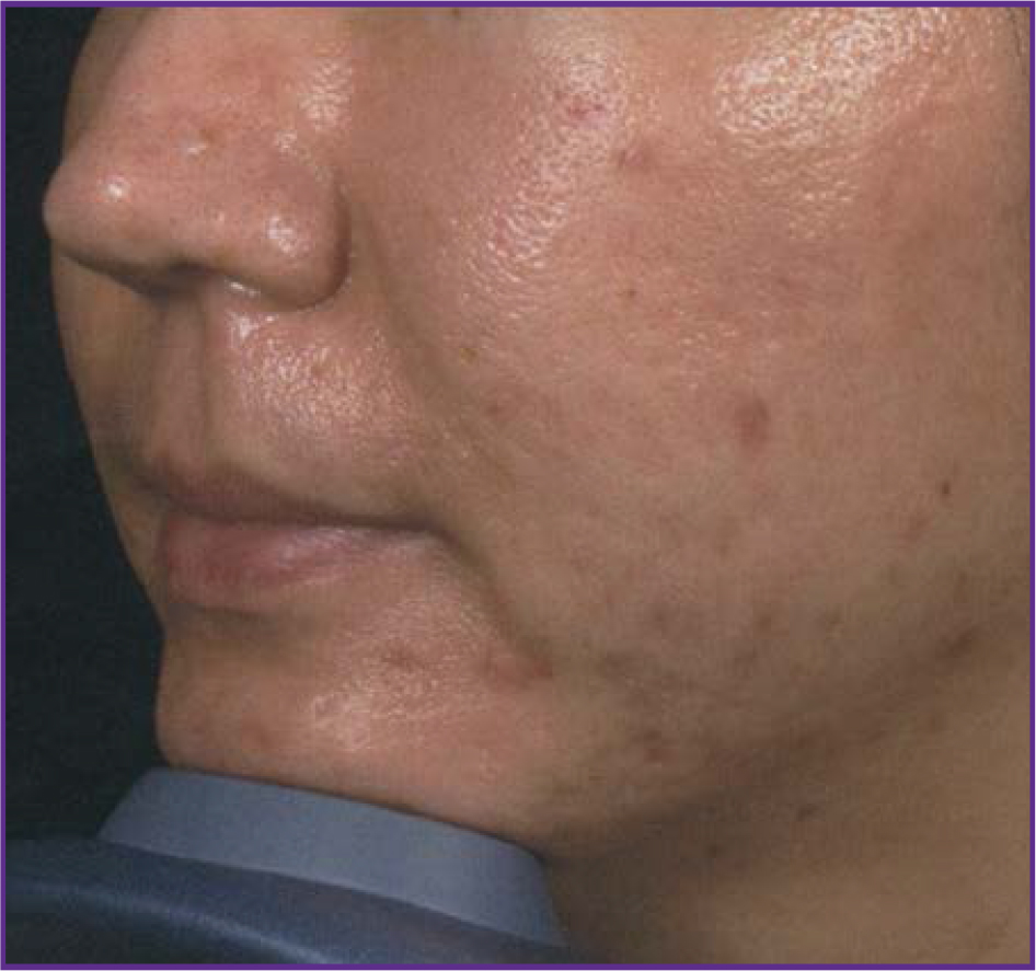 Fractional-Skin-Resurfacing-02-after