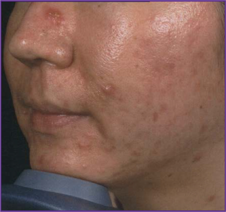 Fractional-Skin-Resurfacing-02-before