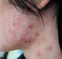 IPL Acne Before