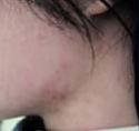 IPL Acne During