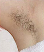 IPL Hair Removal Before