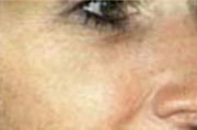 IPL Pigmentation After