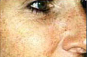 IPL Pigmentation During