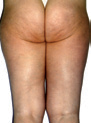 LPG-Cellulite-Smoothing-Treatment-After