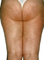 LPG-Cellulite-Smoothing-Treatment-Before