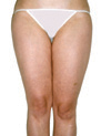 LPG-Draining-Treatment---Aqueous-Cellulite-Before