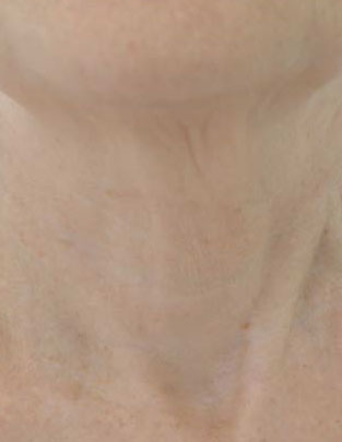Photographs courtesy of Isabelle Rousseaux, M.D., Board Certified Dermatologist, Loos, France