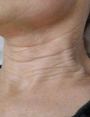 Photographs courtesy of Isabelle Rousseaux, M.D., Board Certified Dermatologist, Loos, France